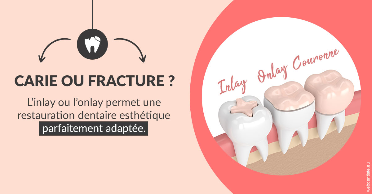 https://dr-nizard-veronique.chirurgiens-dentistes.fr/T2 2023 - Carie ou fracture 2