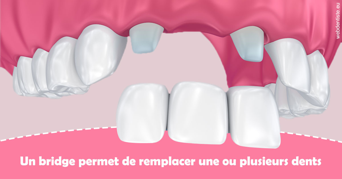 https://dr-nizard-veronique.chirurgiens-dentistes.fr/Bridge remplacer dents 2