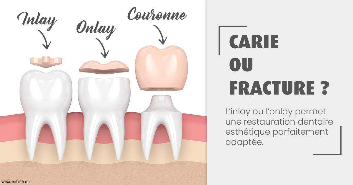 https://dr-nizard-veronique.chirurgiens-dentistes.fr/T2 2023 - Carie ou fracture 1
