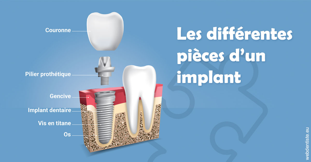 https://dr-nizard-veronique.chirurgiens-dentistes.fr/Les différentes pièces d’un implant 1